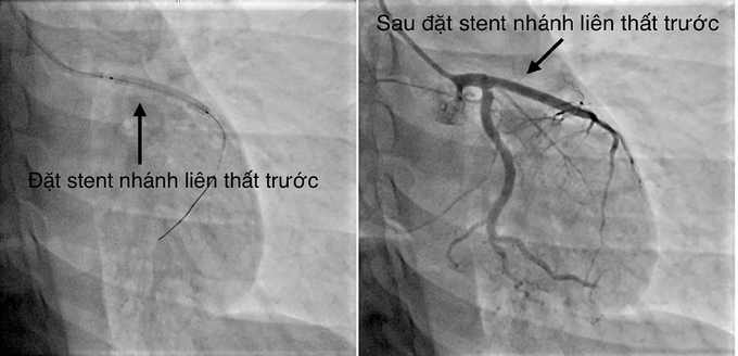 Các bác sĩ đã can thiệp thành công sang thương bằng một stent phủ thuốc sau 35 phút