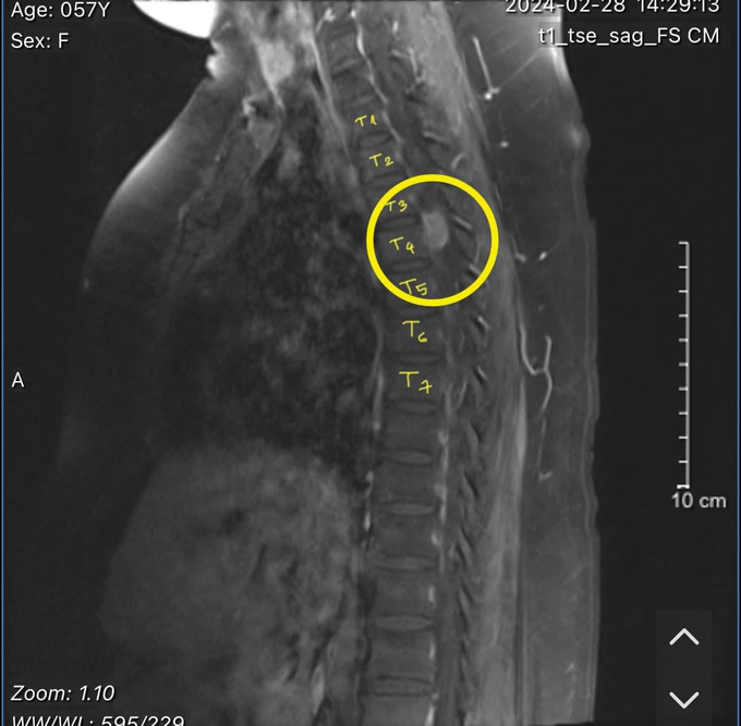 Kết quả chụp MRI cho thấy bị u màng tủy T3-T4 (Ảnh: BVĐKBD)