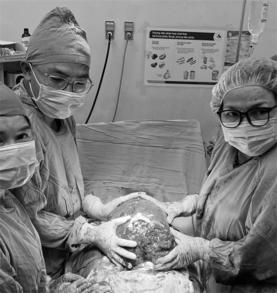 Ê-kip ca phẫu thuật lấy thai song hành cắt bỏ khối u xơ nặng 6,2kg cho sản phụ