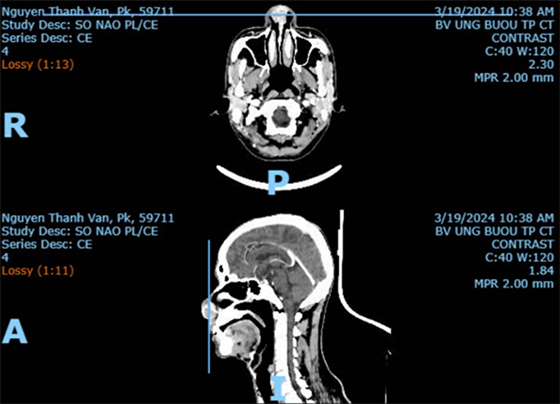 CT scan ghi nhận tổn thương hốc mũi 2 bên, giới hạn không rõ, tăng quang kém d#28x25mm, gây bít hẹp