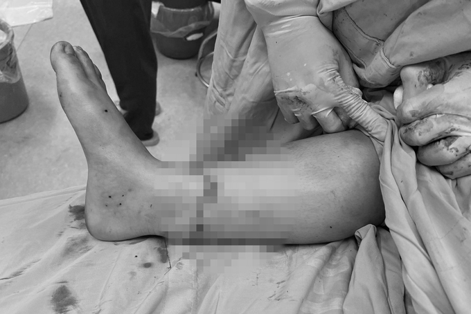 Sau 5 tiếng phẫu thuật, các bác sĩ Bệnh viện Đa khoa vùng Tây Nguyên đã nối liền thành công bàn chân bị đứt rời của bệnh nhân (ảnh: BVCC)