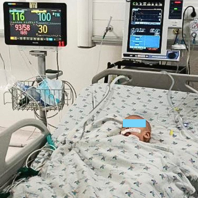 Bệnh viện nhi đồng 2 hỗ trợ cùng bệnh viện nhi đồng thành phố lấy dị vật trong đường thở cho bé trai 8 tháng tuổi