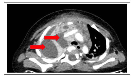  CT scan ngực cho thấy khối áp xe ở trung thất màng phổi phải