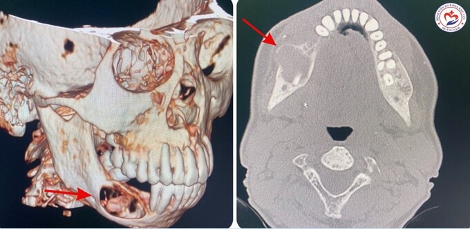 hình ảnh CTScan trước phẫu thuật