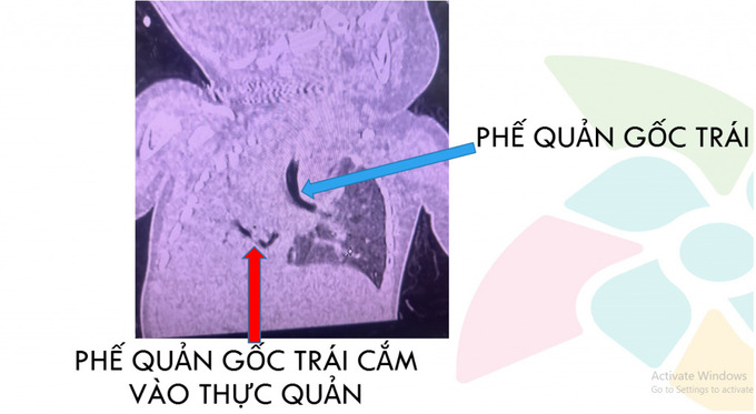 Hình ảnh CT scan đường thở cho thấy phế quản gốc phải xuất phát từ thực quản, xẹp gần hoàn toàn phổi (P)