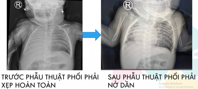 Hình ảnh Xquang phổi trước và sau phẫu thuật