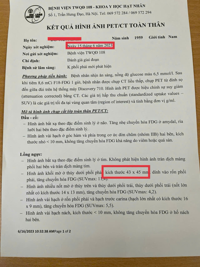 Kích thước u phổi của ông N khi phát hiện