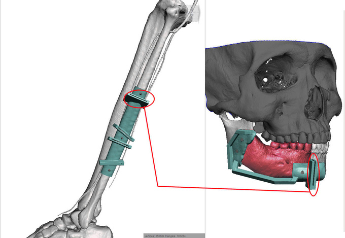 Bệnh viện Quân y 175 ứng dụng công nghệ 3D trong điều trị u nguyên bào men (Ảnh: BVCC)