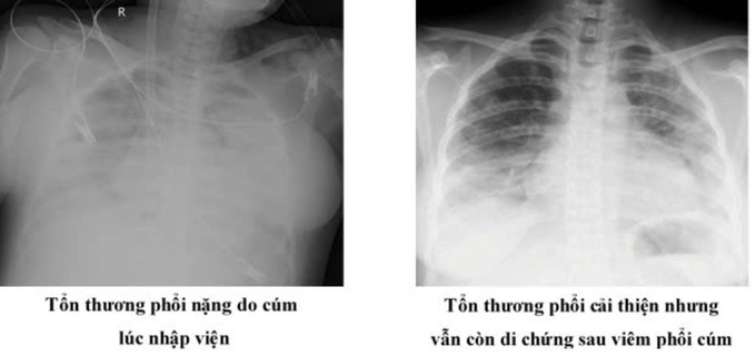 Hình ảnh tổn thương phổi do cúm A của sản phụ N (Ảnh: BVCC)