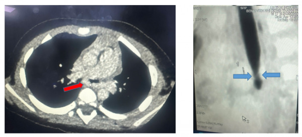 CT scan ngực mặt cắt ngang thấy động mạch phổi trái quấn hẹp khí quản gốc, mặt cắt dọc đứng thấy hẹp khí quản gốc (carina)