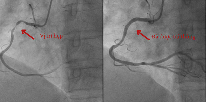 Hình ảnh chụp mạch vành của bệnh nhân H. (Ảnh: BVCC)
