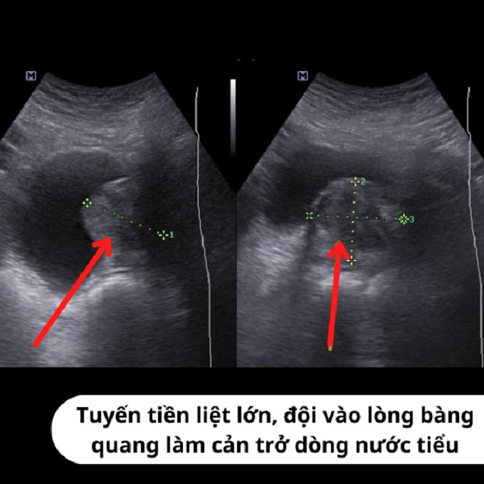 Hình ảnh siêu âm bàng quang (Ảnh: BVCC)