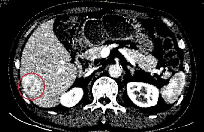 Hình ảnh CT khối u gan (Ảnh: BVCC)