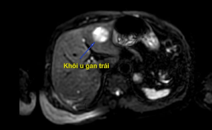 Hình ảnh khối u gan trái trên phim MRI (Ảnh: BVCC)