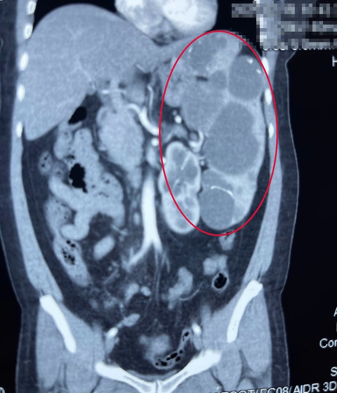 Hình ảnh đa nang lách to được ghi nhận qua CTScan (Ảnh: BVCC)