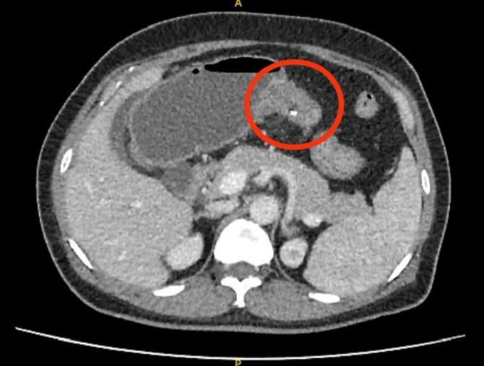 Hình ảnh CT khối u đại tràng của bệnh nhân T. (Ảnh: BVCC)