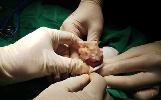 Ung thư dương vật là một bệnh lý hiếm gặp nhưng nguy hiểm, thường khởi phát từ các tổn thương mãn tính vùng bao quy đầu hoặc do nhiễm virus HPV (Ảnh minh hoạ: Nguồn internet)