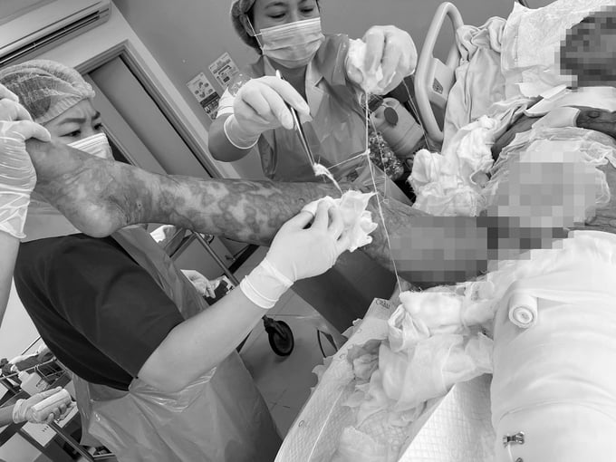 Mỗi lần thay băng kéo dài gần hai giờ, cần 5–6 nhân viên thực hiện phối hợp (Ảnh BVCC)