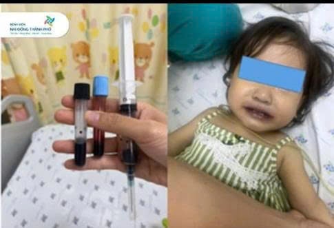 Kết quả “test máu tiếp xúc không khí”, xác nhận mẫu máu giữ màu nâu sẫm thay vì chuyển đỏ tươi - dấu hiệu đặc trưng của methemoglobin máu