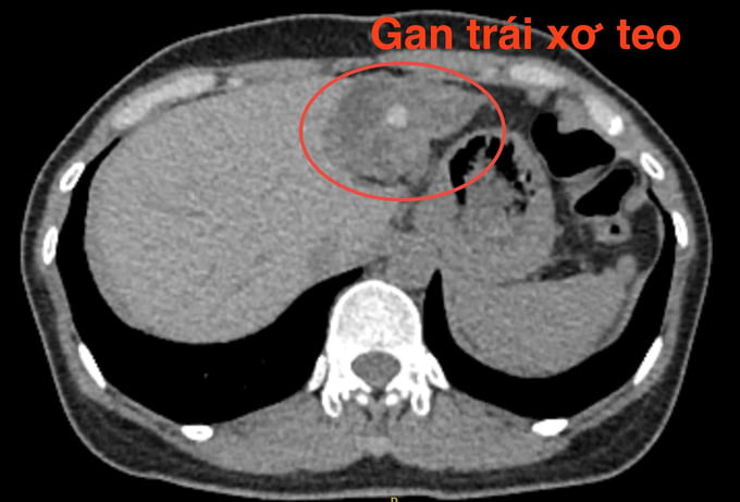 Hình ảnh gan trái teo nhỏ qua CT-scan (Ảnh: BVCC)