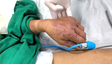 Bệnh nhân nổi ban tím tứ chi.