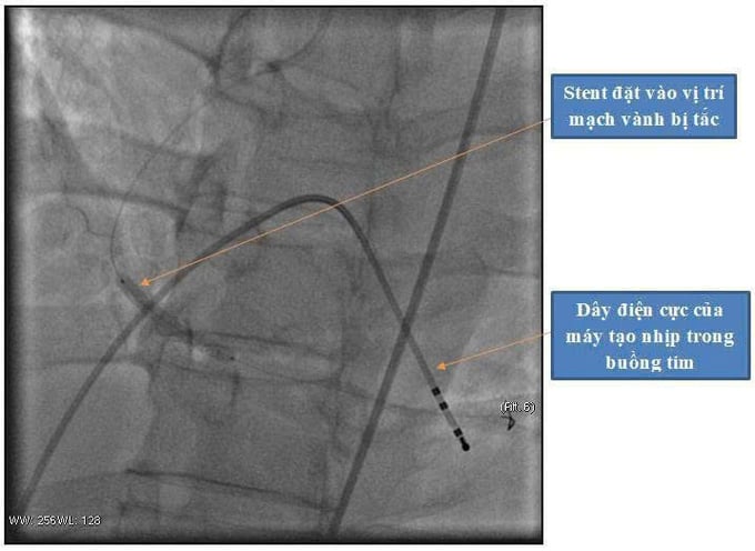 Hình ảnh động mạch vành đã được tái thông sau khi đặt stent