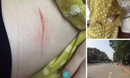 Hà Nội: Cô gái trẻ bị rạch đùi, cướp túi xách ngay giữa ban ngày?